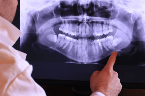 Best Emergency Dentist for Lost Fillings or Crowns in Greenport West, NY